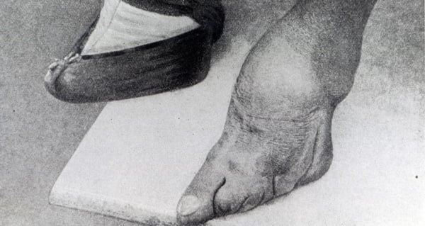 PNP371705 Chinese woman's feet (photo) by Chinese Photographer; Private Collection; (add.info.: Deformation caused by the traditional binding of feet in childhood;); Peter Newark Historical Pictures; Chinese, it is possible that some works by this artist may be protected by third party rights in some territories